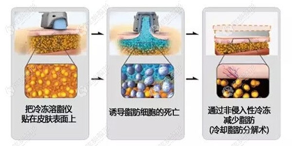 采用酷塑冷冻溶脂的手术原理 采用酷塑冷冻溶脂的手术原理