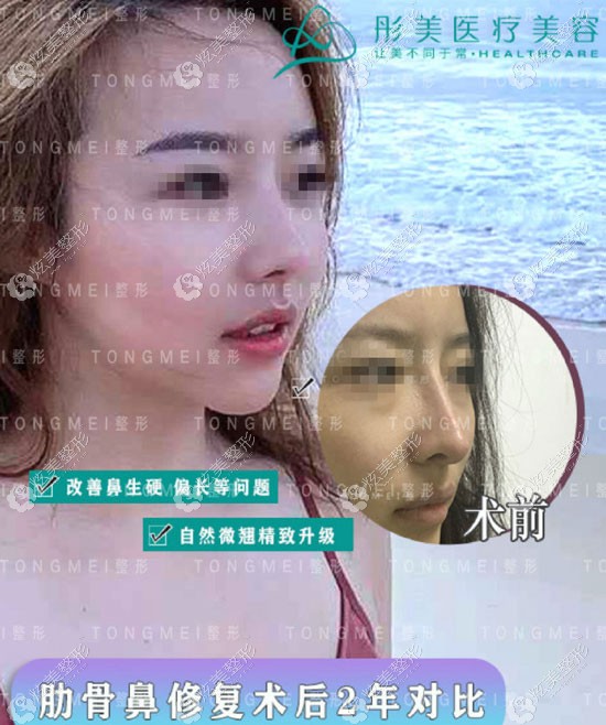 肋软骨鼻修复术后2年鼻子形态自然 肋软骨鼻修复术后2年鼻子形态自然