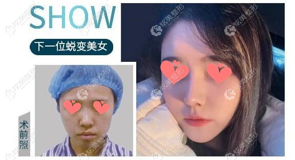 找李长赋医生做全肋软骨隆鼻+鼻基底填充前后对比照 找李长赋医生做全肋软骨隆鼻+鼻基底填充前后对比照