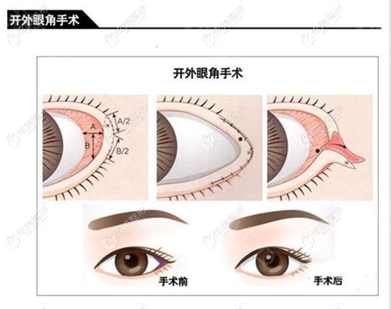开外眼角的手术原理 开外眼角的手术原理