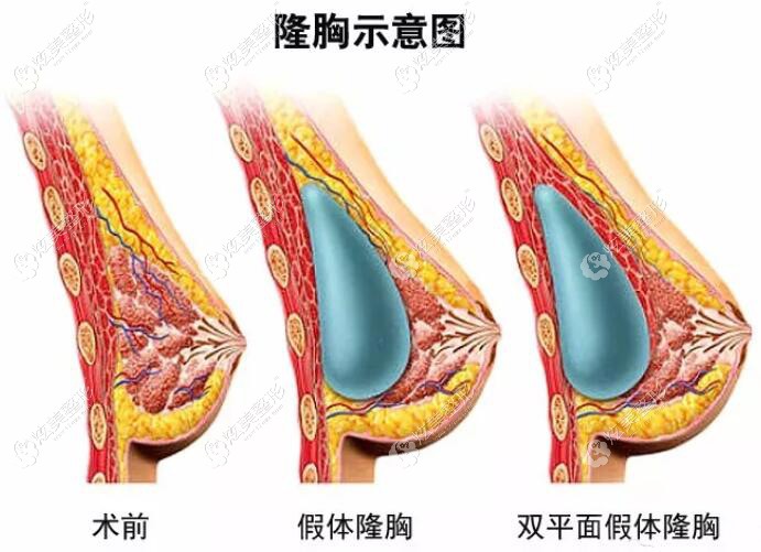 李益泽医生分享双平面隆胸示意图 李益泽医生分享双平面隆胸示意图