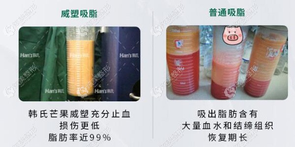 威塑吸脂抽取的脂肪和普通脂肪差别很大 威塑吸脂抽取的脂肪和普通脂肪差别很大