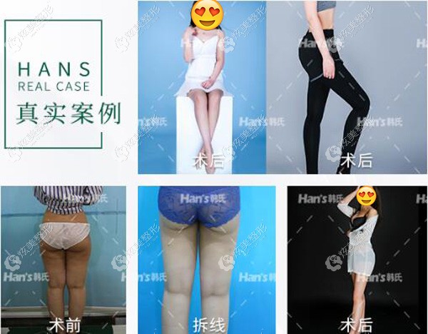 济南韩氏做威塑吸脂的手术效果 济南韩氏做威塑吸脂的手术效果