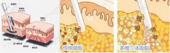 名韩整形改善胯宽大腿粗采用大腿吸脂手术 名韩整形改善胯宽大腿粗采用大腿吸脂手术