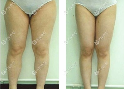 名韩整形做大腿抽脂效果对比 名韩整形做大腿抽脂效果对比