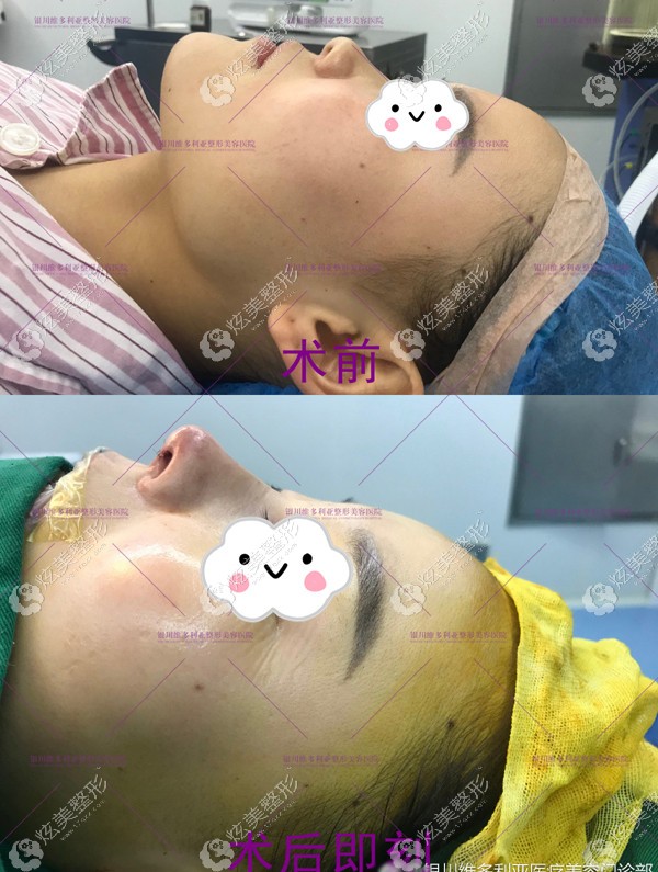 膨体隆鼻+鼻中隔软骨塑鼻尖前后对比照 膨体隆鼻+鼻中隔软骨塑鼻尖前后对比照