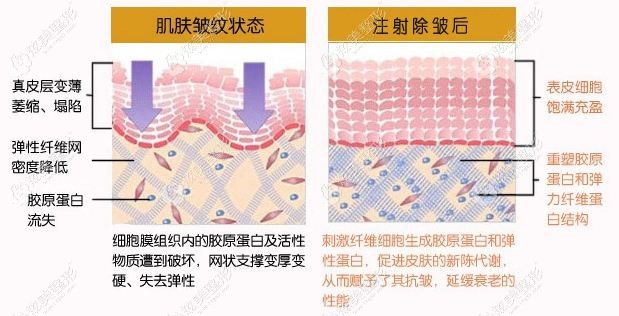 注射除皱的原理 注射除皱的原理