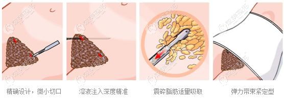 大连星妍做腰腹环吸手术 大连星妍做腰腹环吸手术