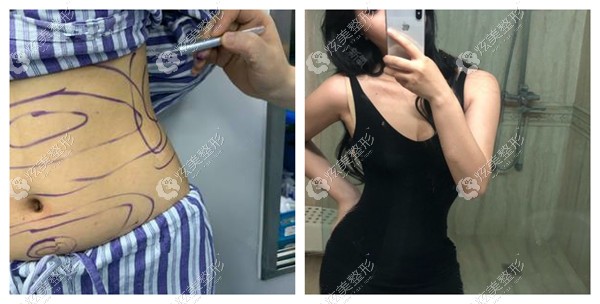 星妍整形做腰腹吸脂案例 星妍整形做腰腹吸脂案例