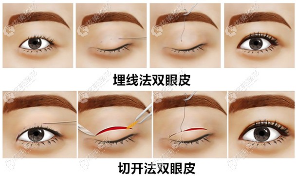 me双眼皮说白了就是埋线的原理,只不过所使用的缝线是不可吸收的,另外