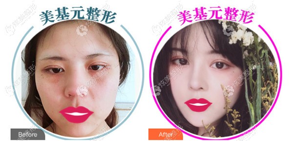 汪福强隆鼻效果对比 汪福强隆鼻效果对比