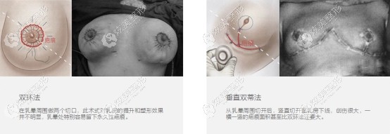 传统乳房悬吊提升留疤明显 传统乳房悬吊提升留疤明显