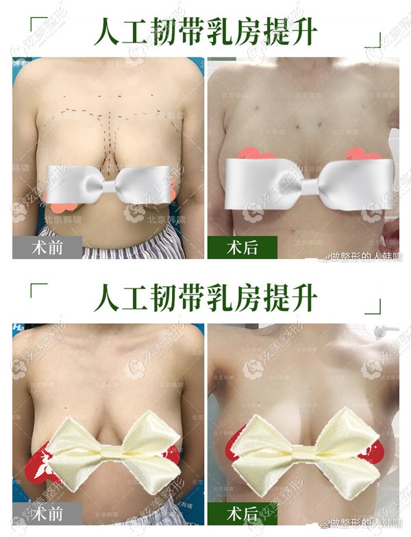 韩啸医生做不开刀人工韧带乳房上提术案例对比 韩啸医生做不开刀人工韧带乳房上提术案例对比