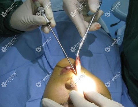 隆鼻假体取出手术 隆鼻假体取出手术