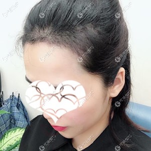 在杭州大麦做发际线植发后进入脱落期 在杭州大麦做发际线植发后进入脱落期
