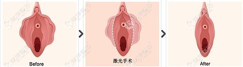 王娜医生做阴唇缩小案例 王娜医生做阴唇缩小案例
