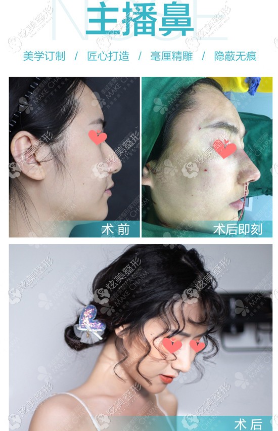 驼峰鼻矫正+自体耳软骨的鼻综合手术对比照 驼峰鼻矫正+自体耳软骨的鼻综合手术对比照