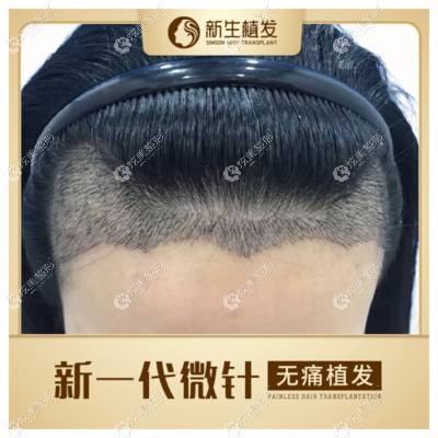 广州越秀区毛发医院用3d技术种植一次发际线多少钱
