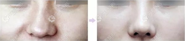 天津欧菲歪鼻矫正案例 天津欧菲歪鼻矫正案例