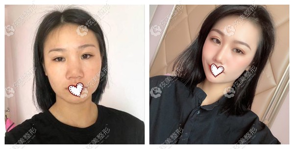 欧菲整形做隆鼻失败修复对比图 欧菲整形做隆鼻失败修复对比图