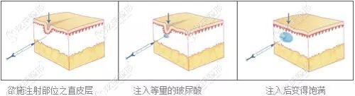 徐院长采用玻尿酸注射除皱 徐院长采用玻尿酸注射除皱