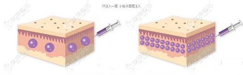 张绍斌院长做脂肪填充过程 张绍斌院长做脂肪填充过程