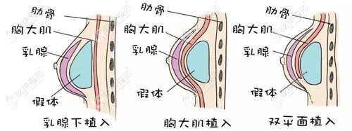 詹院长做隆胸手术的原理