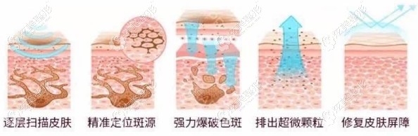 m22王者之冠祛斑过程 m22王者之冠祛斑过程