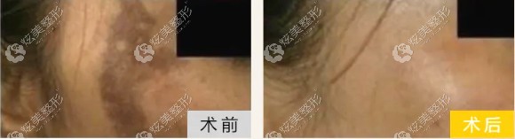 美国c10祛除黄褐斑效果 美国c10祛除黄褐斑效果
