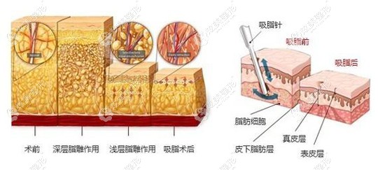 席主任做吸脂手术的原理 席主任做吸脂手术的原理