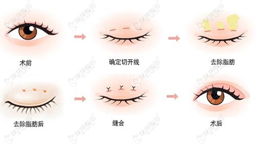 张院长做眼综合的手术原理 张院长做眼综合的手术原理