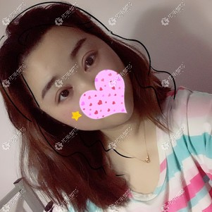 闫腾元医生为我做小眼综合后恢复效果 闫腾元医生为我做小眼综合后恢复效果