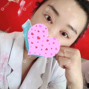 在天津欧菲做完眼综合后眼睛肿胀 在天津欧菲做完眼综合后眼睛肿胀