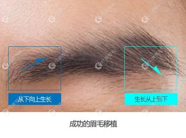 种植成功的眉毛呈现的效果 种植成功的眉毛呈现的效果
