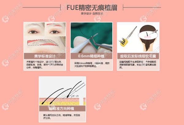 FUE植眉手术原理 FUE植眉手术原理