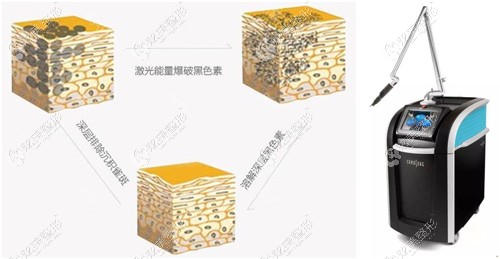 张医生做皮秒激光祛斑的原理 张医生做皮秒激光祛斑的原理