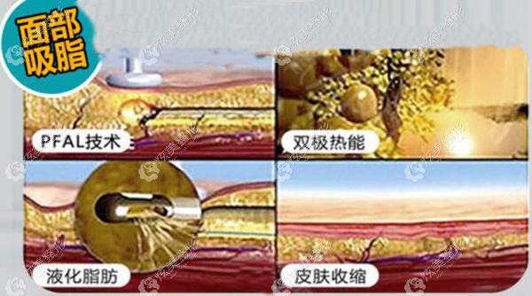 高院长做吸脂手术的示意图 高院长做吸脂手术的示意图