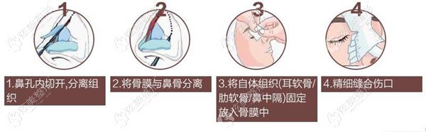 曹倍正做鼻整形过程 曹倍正做鼻整形过程