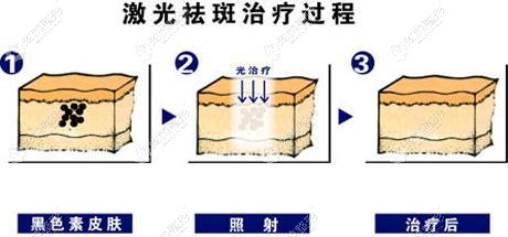 林医生做皮秒激光祛斑的原理 林医生做皮秒激光祛斑的原理