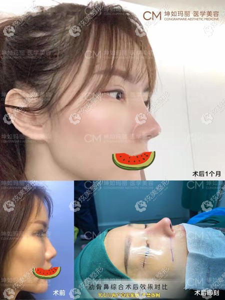 天津坤如玛丽整形做鼻综合前后对比图 天津坤如玛丽整形做鼻综合前后对比图