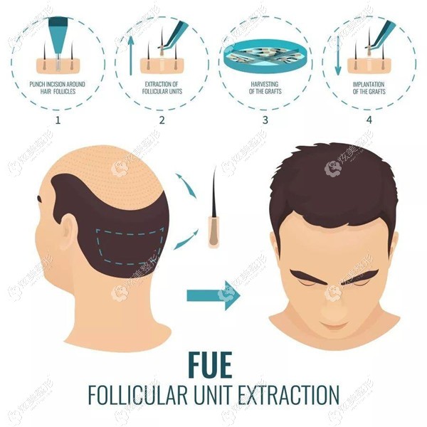 陈海亮医生做是第二代FUE植发手术 陈海亮医生做是第二代FUE植发手术