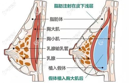 陈院长做复合式隆胸的手术原理 陈院长做复合式隆胸的手术原理
