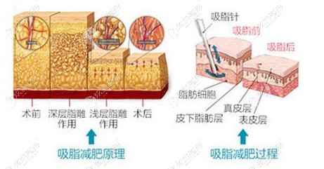 翟爽医生做吸脂手术过程 翟爽医生做吸脂手术过程