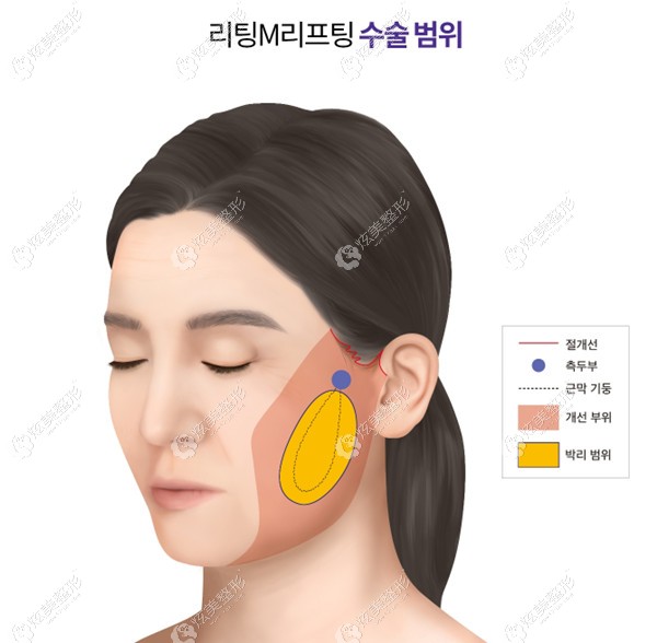 liting整形院长李成俊做提升手术过程 liting整形院长李成俊做提升手术过程