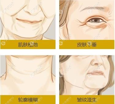 眼部音波提拉手术适合眼周皮肤下垂的人群 眼部音波提拉手术适合眼周皮肤下垂的人群