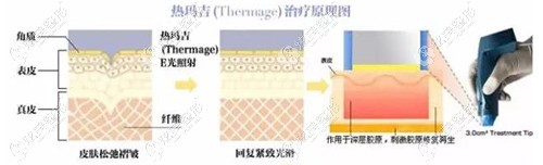 刘医生做热玛吉除皱的原理 刘医生做热玛吉除皱的原理