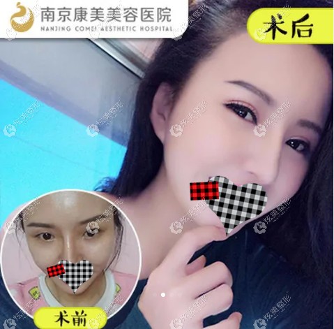 南京陈小剑医生做双眼皮修复图 南京陈小剑医生做双眼皮修复图