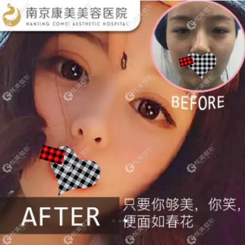 陈小剑医生做双眼皮修复对比 陈小剑医生做双眼皮修复对比