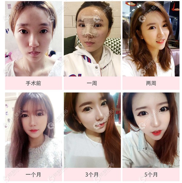梁桐准医生做的Softxil硅胶假体隆鼻术后恢复效果 梁桐准医生做的Softxil硅胶假体隆鼻术后恢复效果