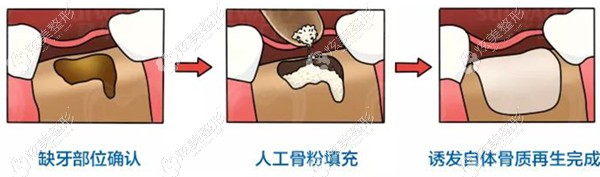 武汉瑞博口腔做种植牙需要添加骨粉价格会更贵 武汉瑞博口腔做种植牙需要添加骨粉价格会更贵